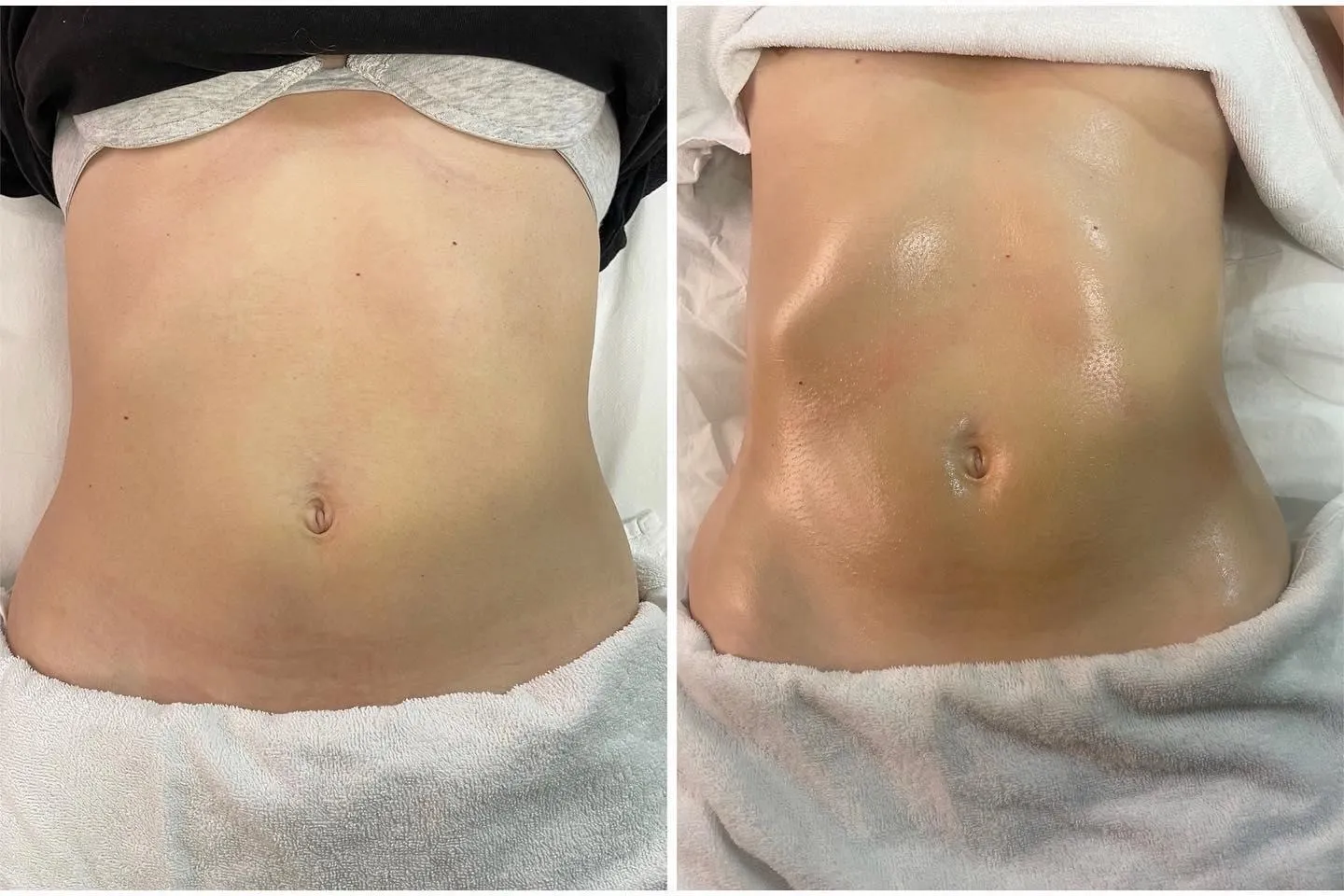 Antes y después de un tratamiento corporal de abdomen