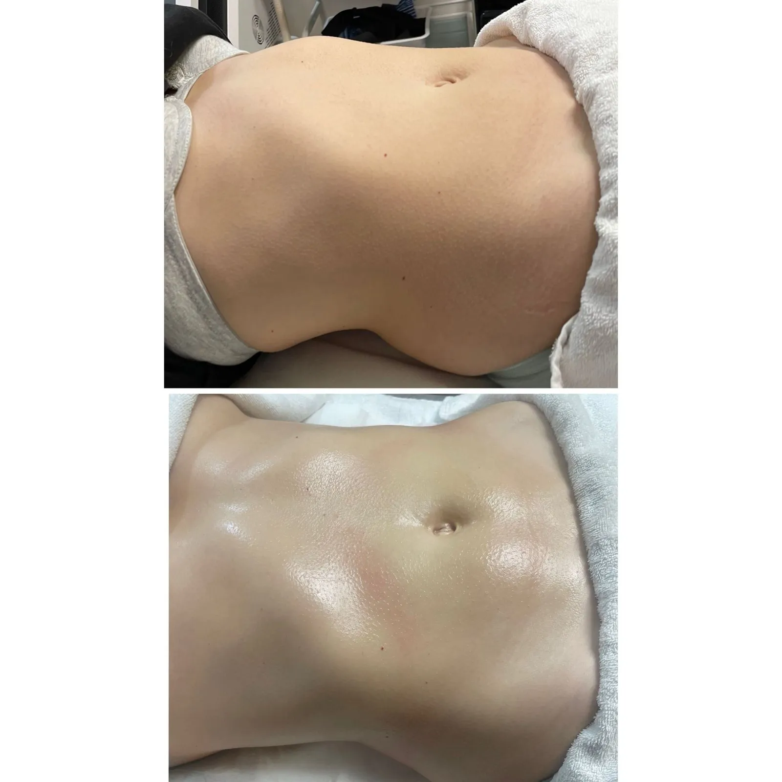 Antes y después de un moldeamiento corporal brasileño