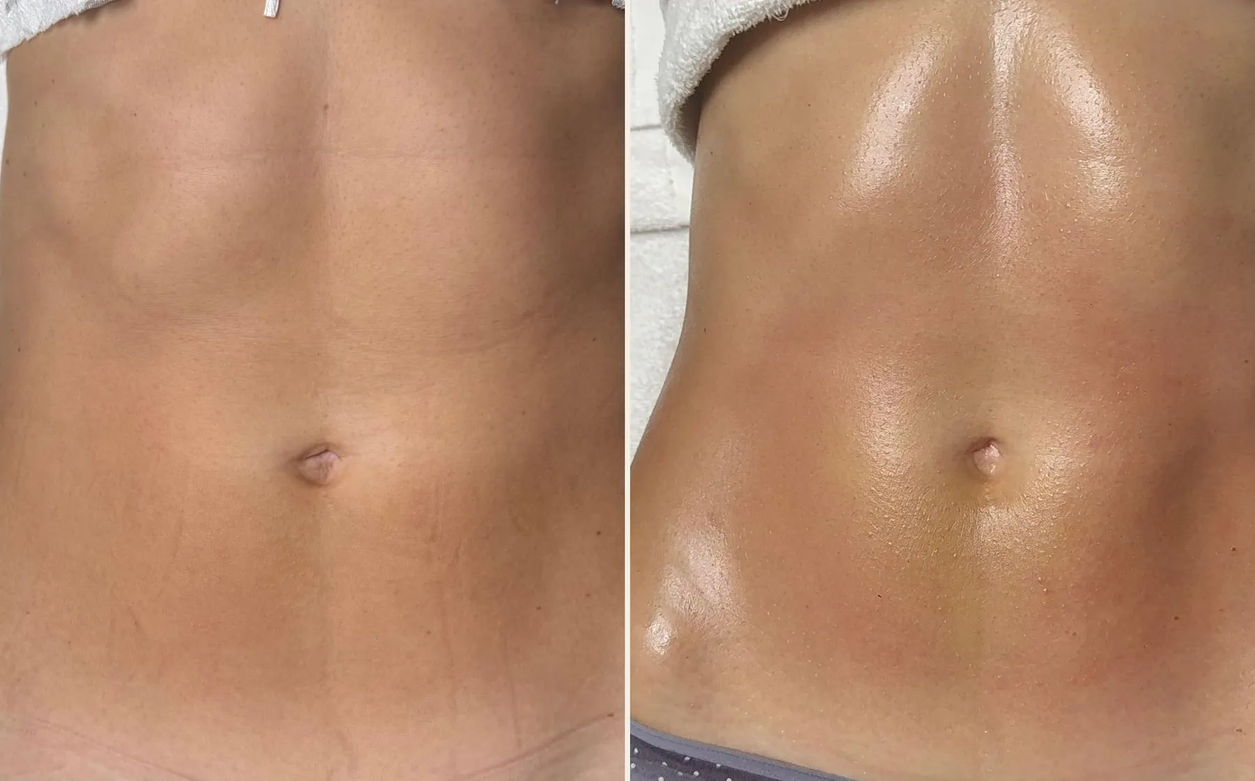 Antes y después de un tratamiento corporal de abdomen en Plasma Estetic