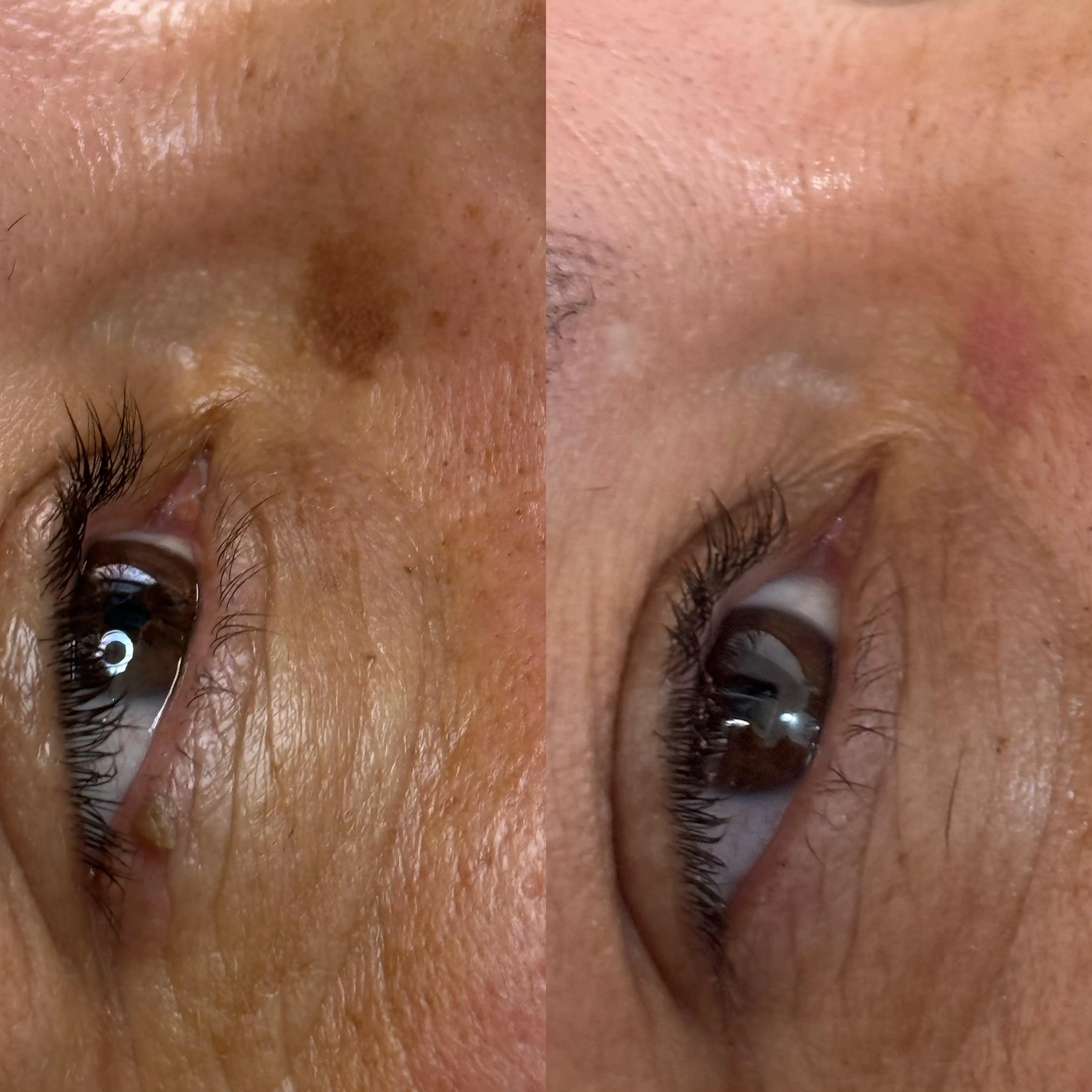 Antes y después de un tratamiento de manchas en el párpado con Plasma Pen en Plasma Estetic